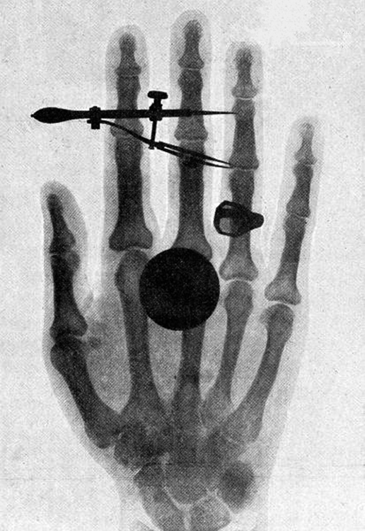 One of the first x-ray images, taken by Röentgen himself. The hand belongs to Bertha Röentgen, his wife.